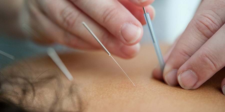 Electro-Acupuncture  What Does E-Stim Feel Like - Does it hurt?